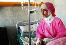Iran : nouvelle agression à l’acide d’une jeune femme par des criminels des pasdaran Iran