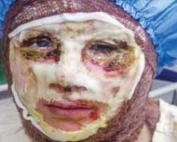 Iran acid attack