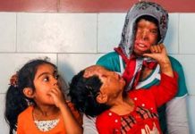 Ra’na, la petite victime des attaques à l’acide en Iran sous le règne de Rohani Ra’na, la petite victime des attaques à l’acide en Iran sous le règne de Rohani